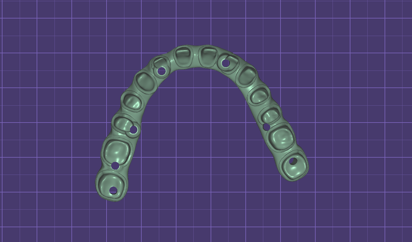 Hybrid implant bridge